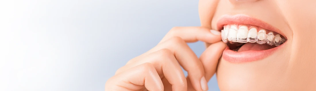 Clear Aligners in Granada Hills CA